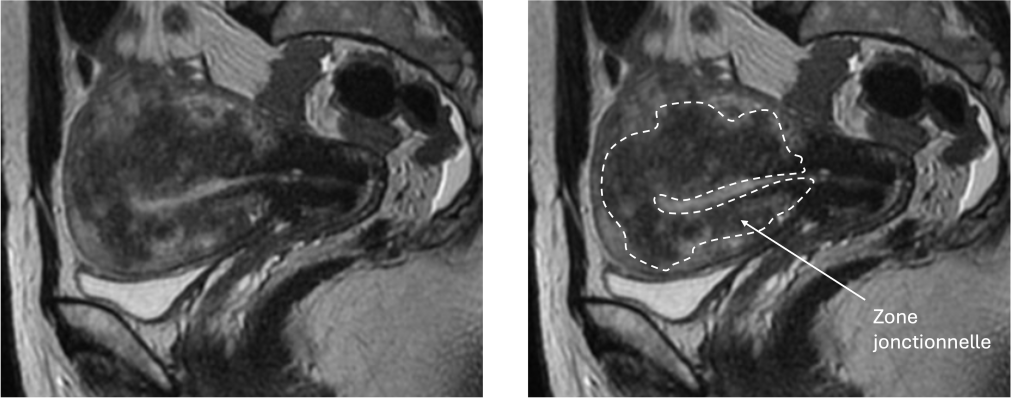 IRM annotée en coupe sagittale d'adenomyose