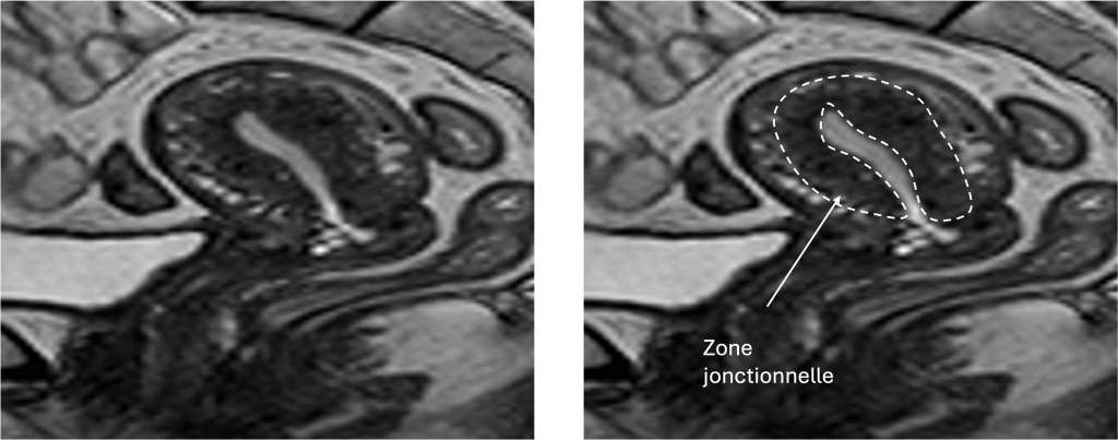IRM annotée en coupe sagittale d'un utérus normal avec zone jonctionnelle non épaissie