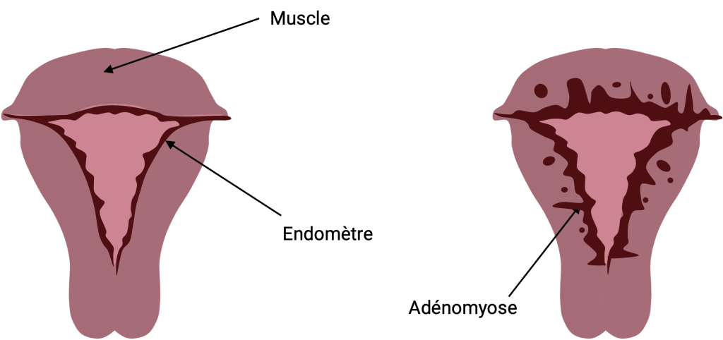 Schéma annoté d'un utérus avec les différents parties muscle endométre et d'un utérus avec épaississement de la zone jonctionnelle en rapport avec de l'adenomyose