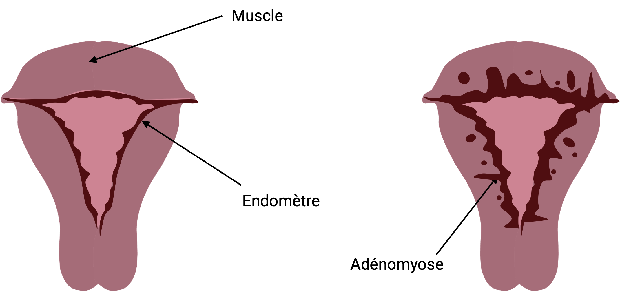 Adénomyose : causes, symptômes et diagnostic