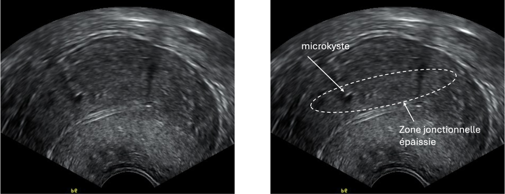Echographie annotée en coupe sagittale d'adenomyose
