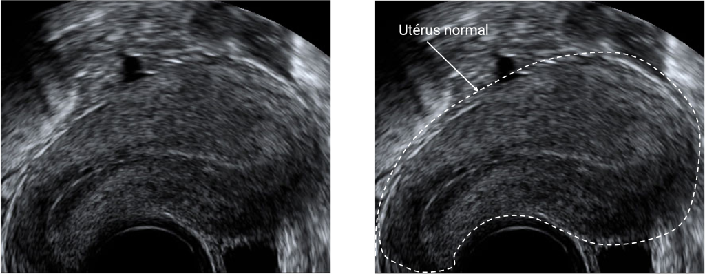 Echographie annotée en coupe sagittale d'un utérus normal
