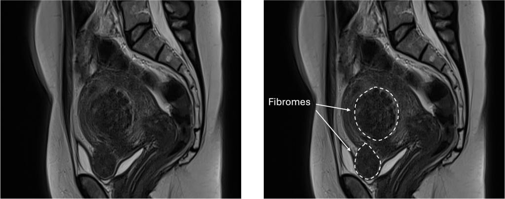 IRM annotée d'un utérus avec fibromes