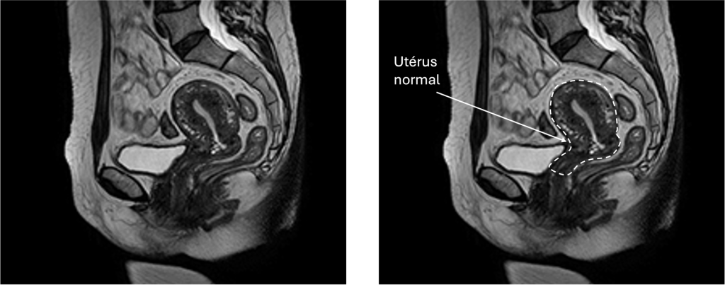 IRM annotée d'un uterus normal en coupe sagittal