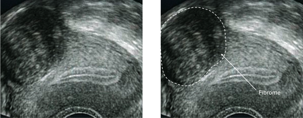 échographie annotée d'un utérus avec fibrome sous séreux