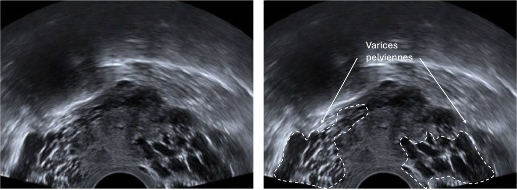 echogaphie de varices pelvienne annotée chez une femme avec un syndrome de congestion pelvienne