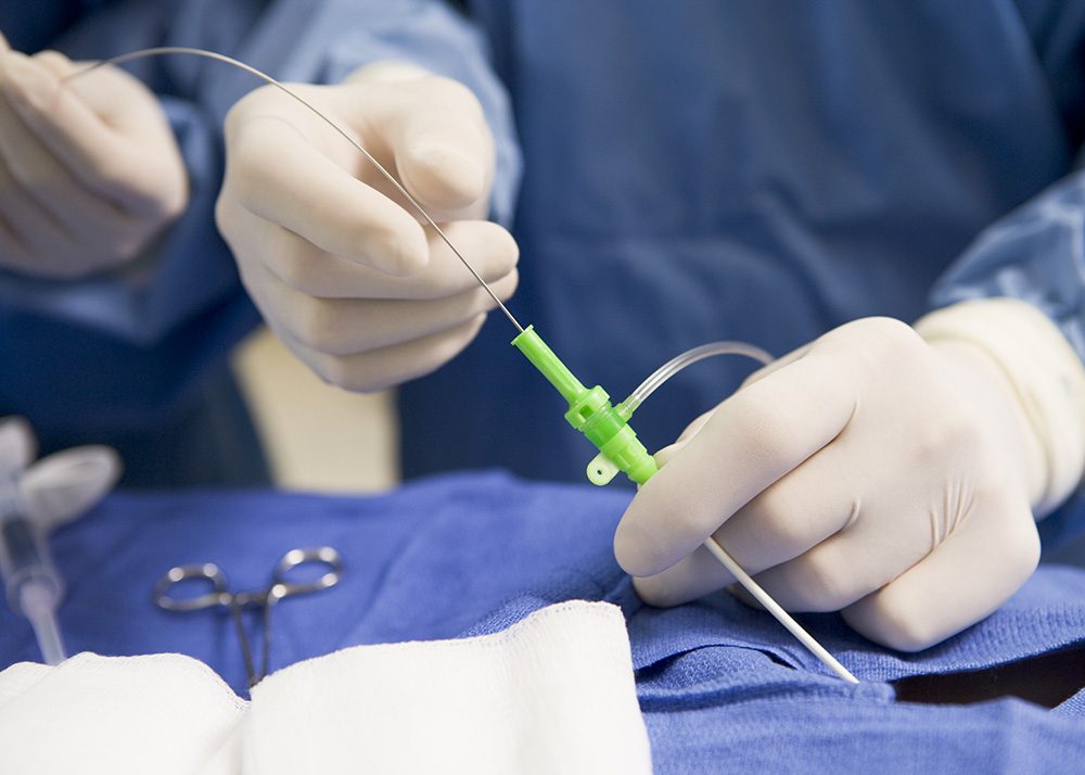 Début d'une intervention d'embolisation des arteres uterines pour uterus avec fibromes