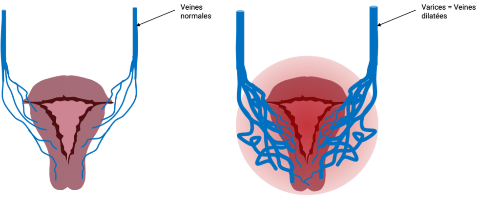 Schéma annoté des varices pelviennes et du syndrome de congestion pelvienne