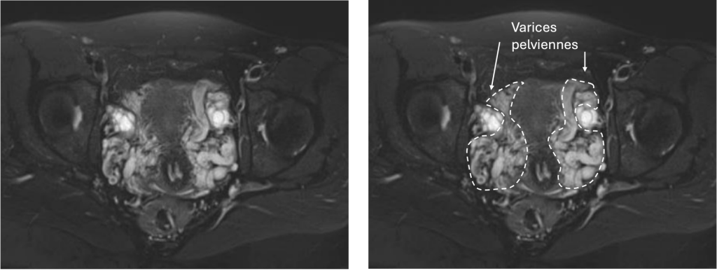 IRM annoté de varices pelviennes chez une femme avec syndrome de congestion pelvienne