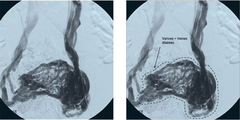 Phlebographie avec explication de varices pelviennes