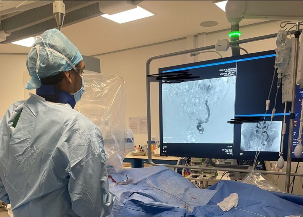 Image d'une embolisation de varices pelvienne au bloc de radiologie interventionnel par le Docteur vauclin